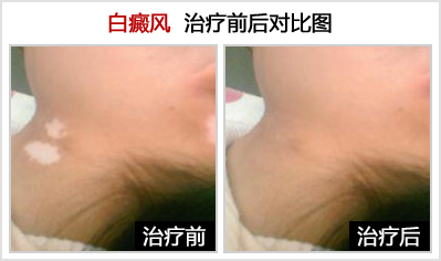 白癜风的护理?-lni